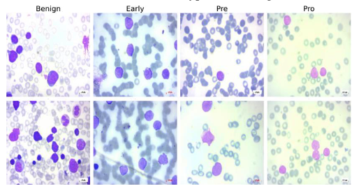 Acute Lymphoblastic Leukemia Classification: Deep Learning Techniques for Blood Diseases Diagnosis